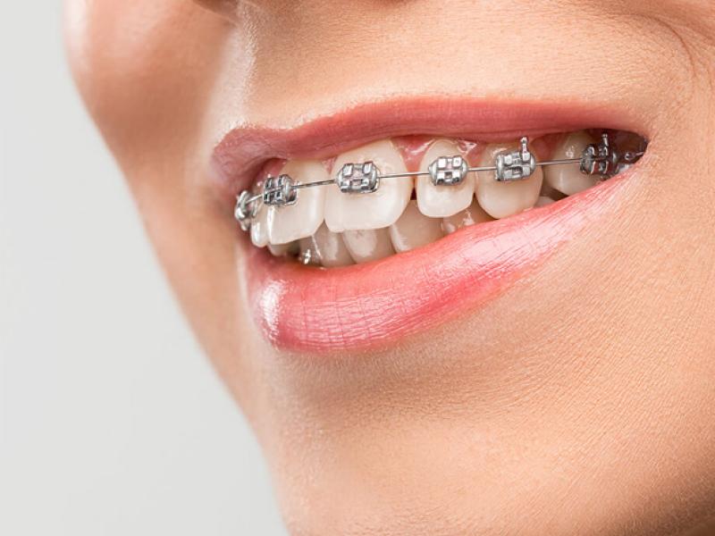 Types of braces available in Turkey 2026