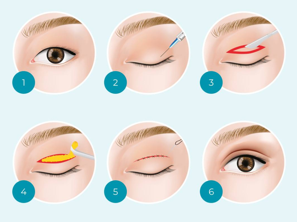 Blepharoplasty process (upper and lower) 2026 Blepharoplasty process (upper and lower) 2026