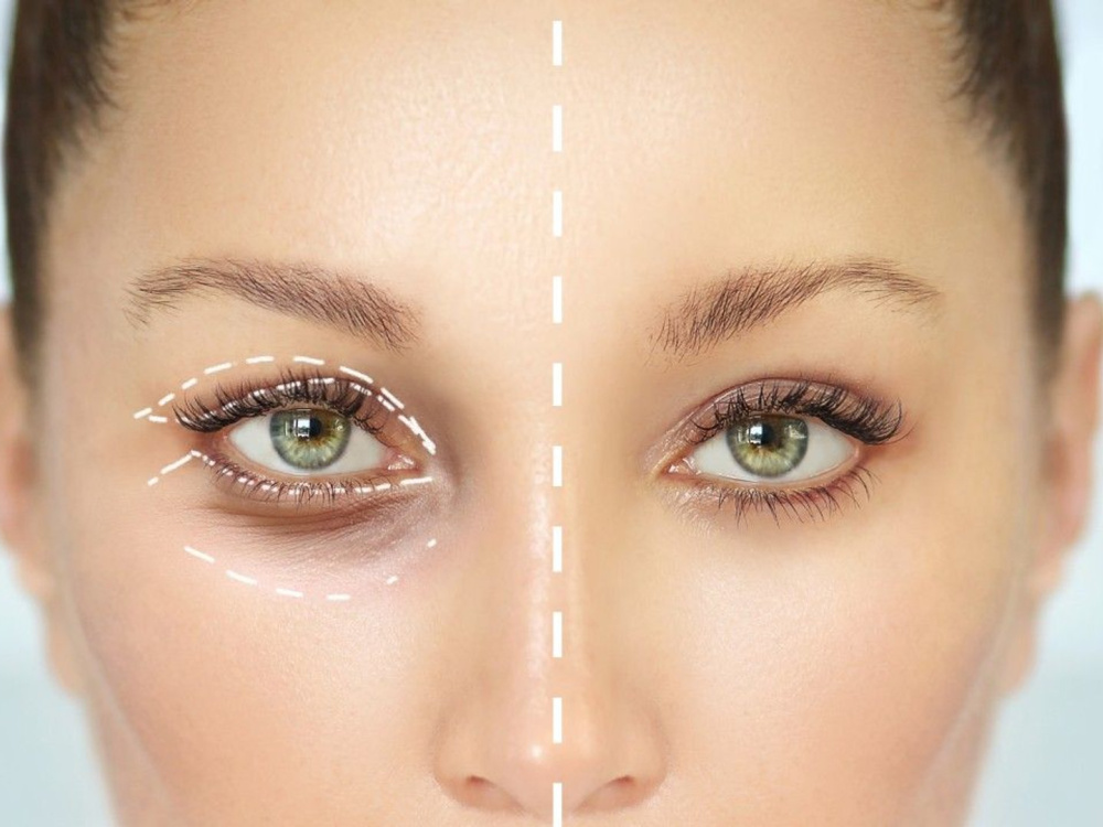 Indications for blepharoplasty 2026 Indications for blepharoplasty 2026