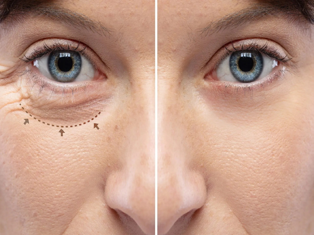 blefaroplastia en Turquía
