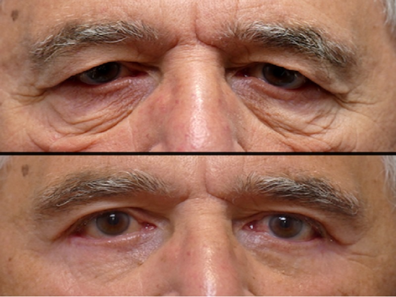 Unilateral blepharoplasty in Turkey & Istanbul Reviews, Price from 950€