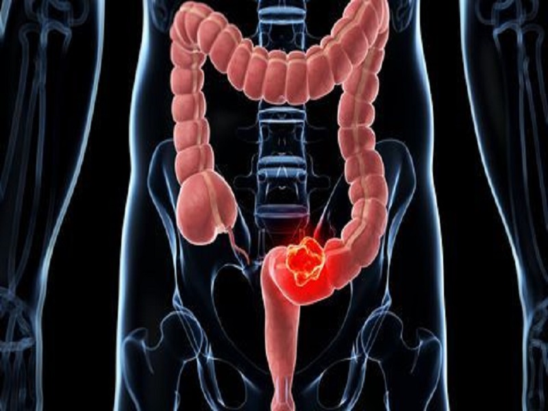 Factores de riesgo del cáncer colorrectal 2026