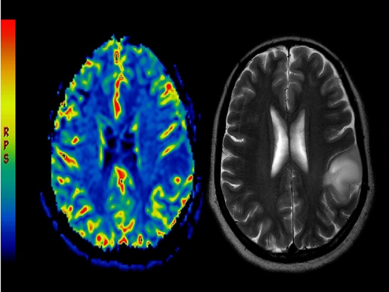 Une Tumeur Au Cerveau Peut Elle Disparaitre Cancer du Cerveau Turquie, Prix & Cliniques