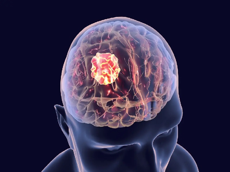 Une Tumeur Au Cerveau Peut Elle Disparaitre Cancer du Cerveau Turquie, Prix & Cliniques