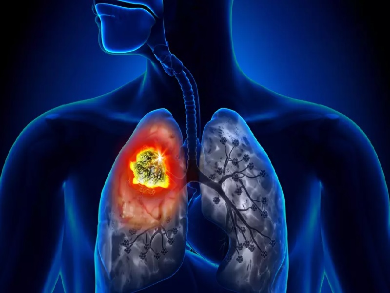 Formas de cáncer de pulmón 2026