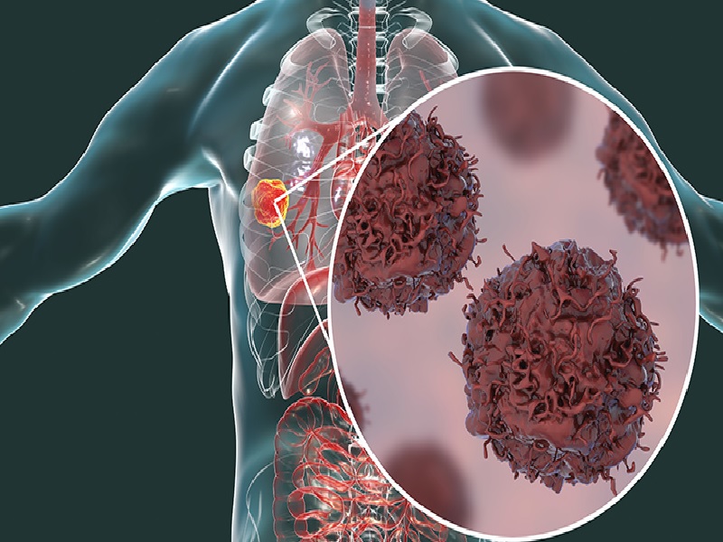 Cáncer de pulmón: Causas y factores de riesgo 2026