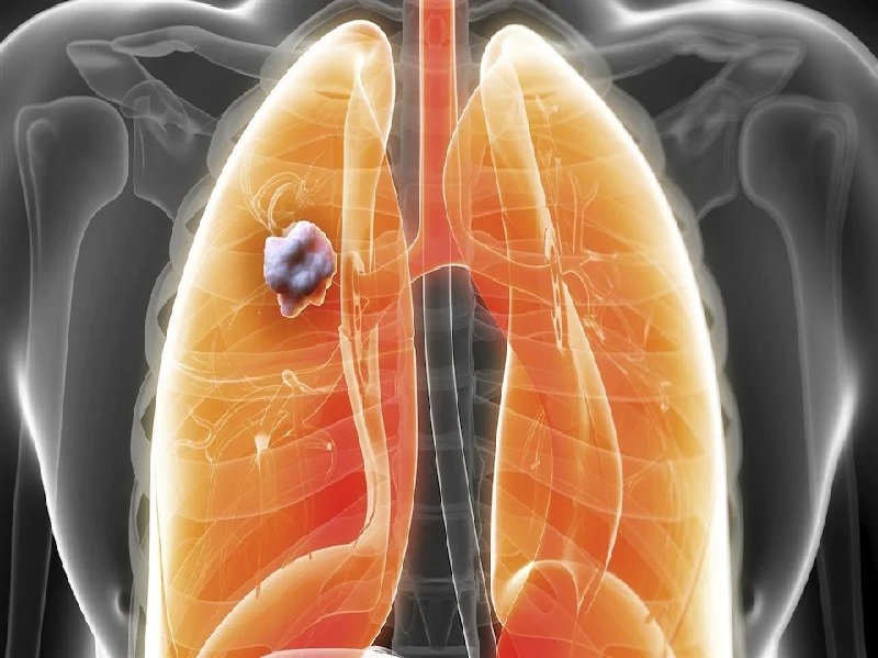 Diagnóstico del cáncer de pulmón en Estambul 2026