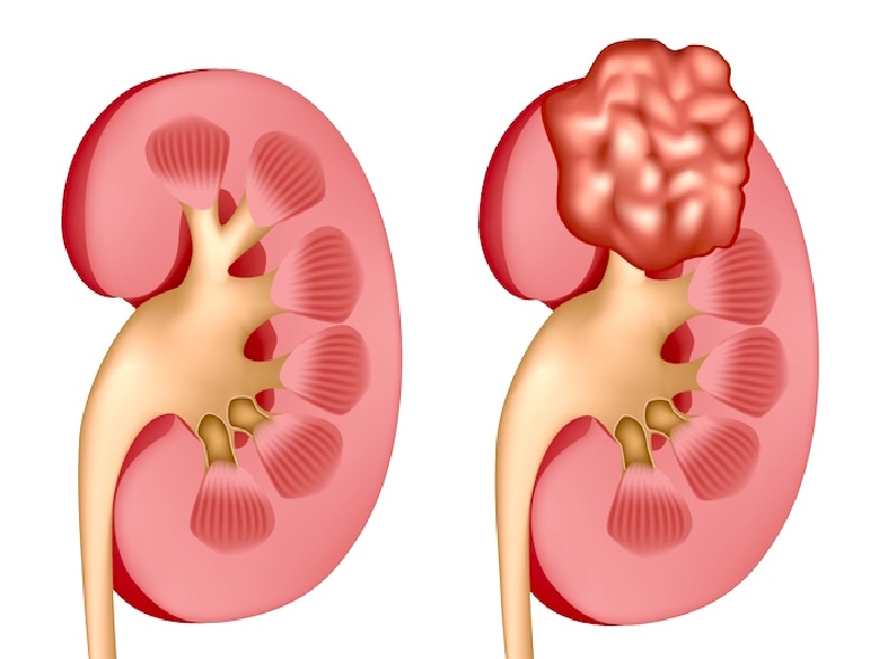 Risk factors for kidney cancer 2026