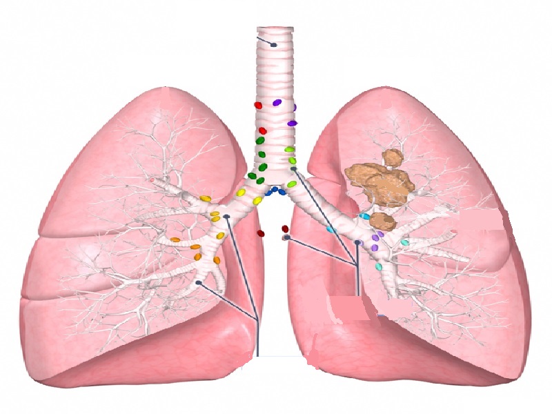 Opciones de tratamiento del cáncer de pulmón en Turquía 2026