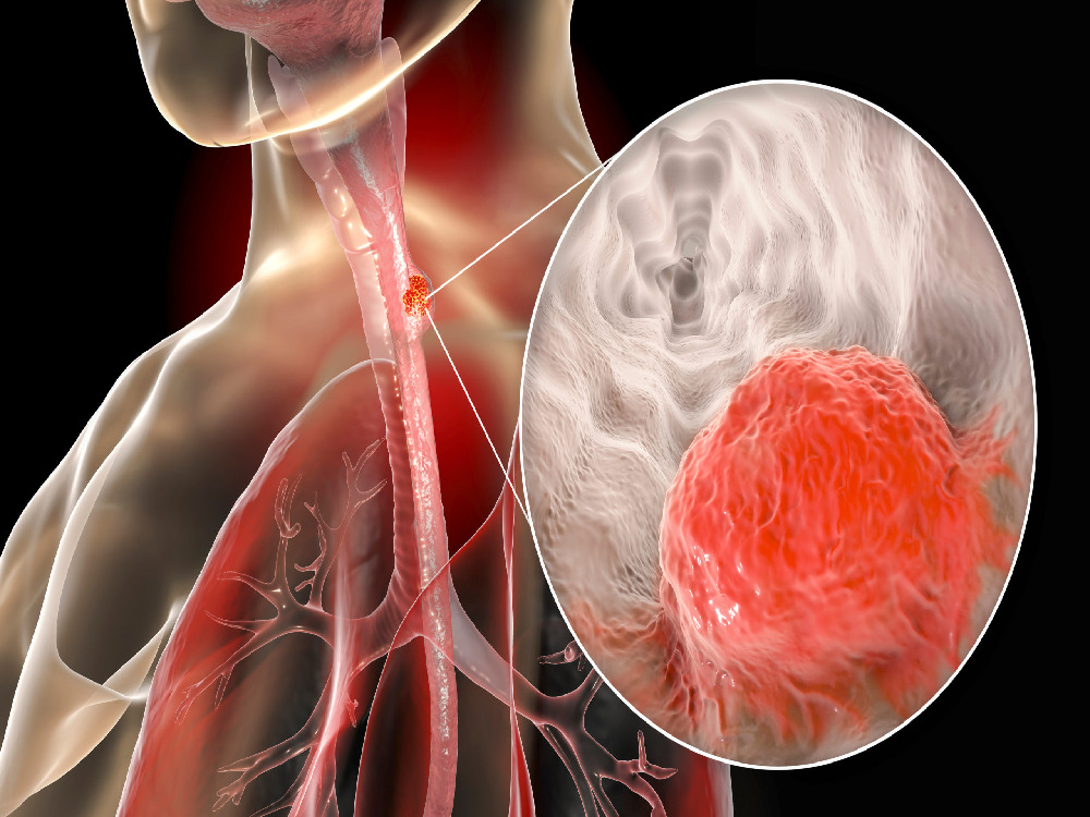 Treatment of esophageal diverticula in Turkey Treatment of esophageal diverticula in Turkey