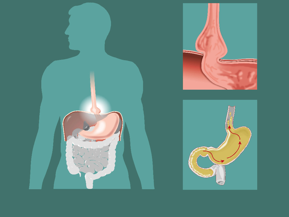 Causes des hernies hiatales