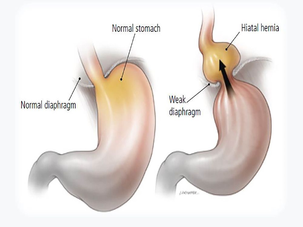 Diagnostic de la hernie hiatale