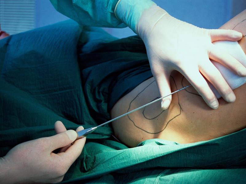 Understanding lipedema 2026