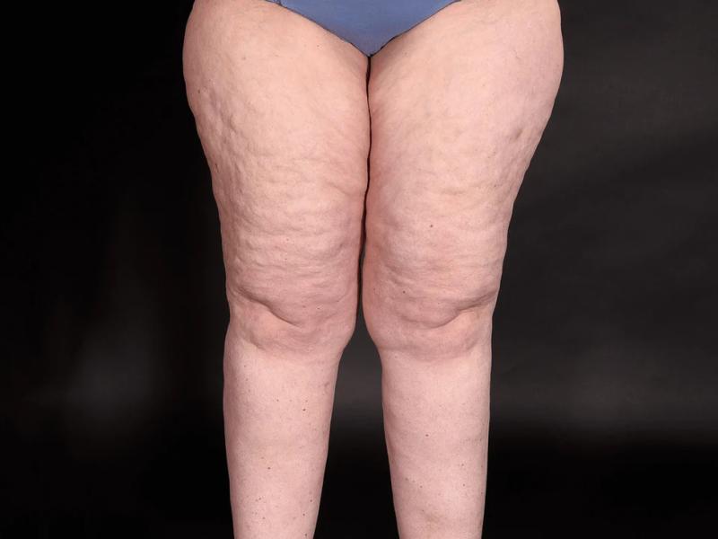 Why lipedema surgery might be right for you 2026