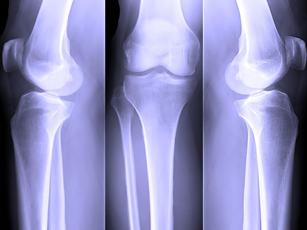 Meniscus tear surgery in Turkey