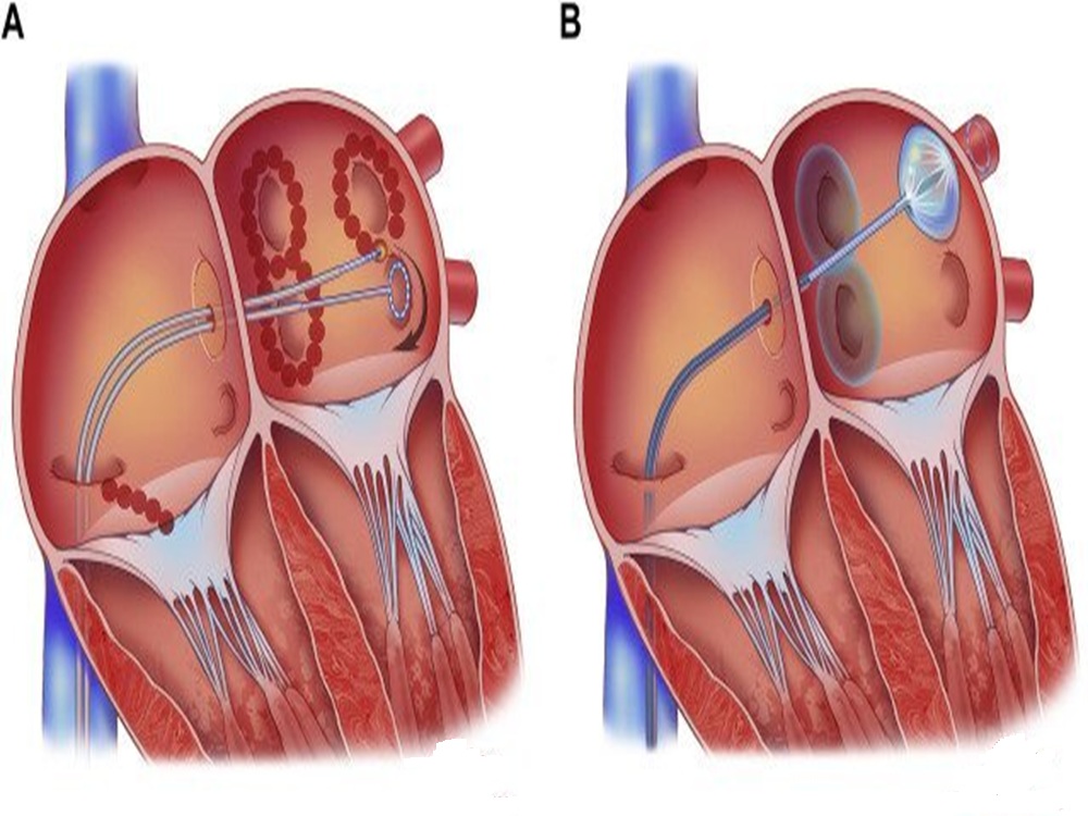 cardiac cryotherapy