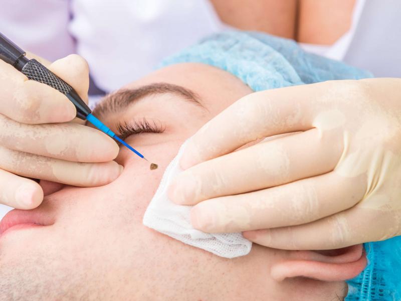 Is it effective to remove a mole at home? 2026