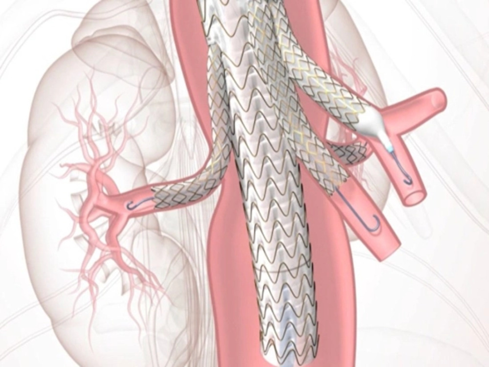 endovascular EVAR & TEVAR procedures endovascular EVAR & TEVAR procedures