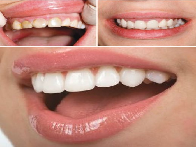 Dental veneers in Turkey and Istanbul, Price from 300