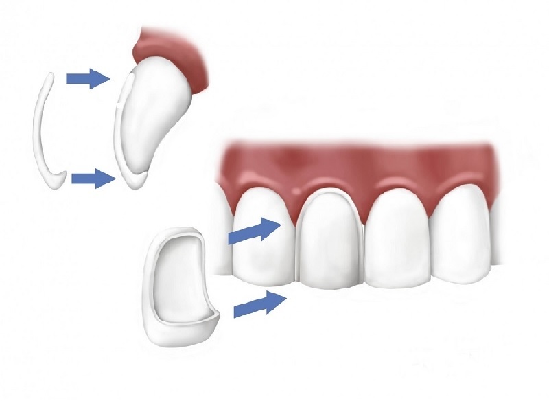 Dental veneers Turkey Dental veneers Turkey