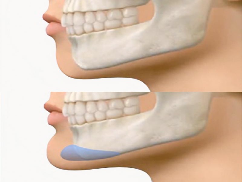 Chin surgery indications: How genioplasty enhances facial harmony 2026