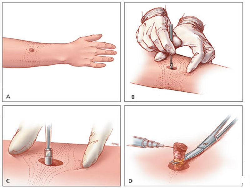 Mole removal in Turkey: laser or scalpel 2026
