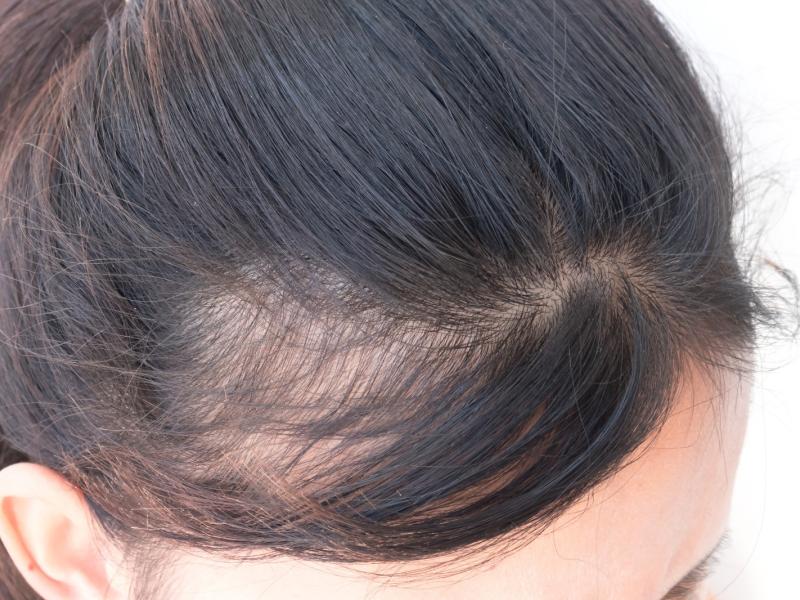 متى يمكنك اختيار زراعة الشعر بدون حلاقة؟ 2026 متى يمكنك اختيار زراعة الشعر بدون حلاقة؟ 2026