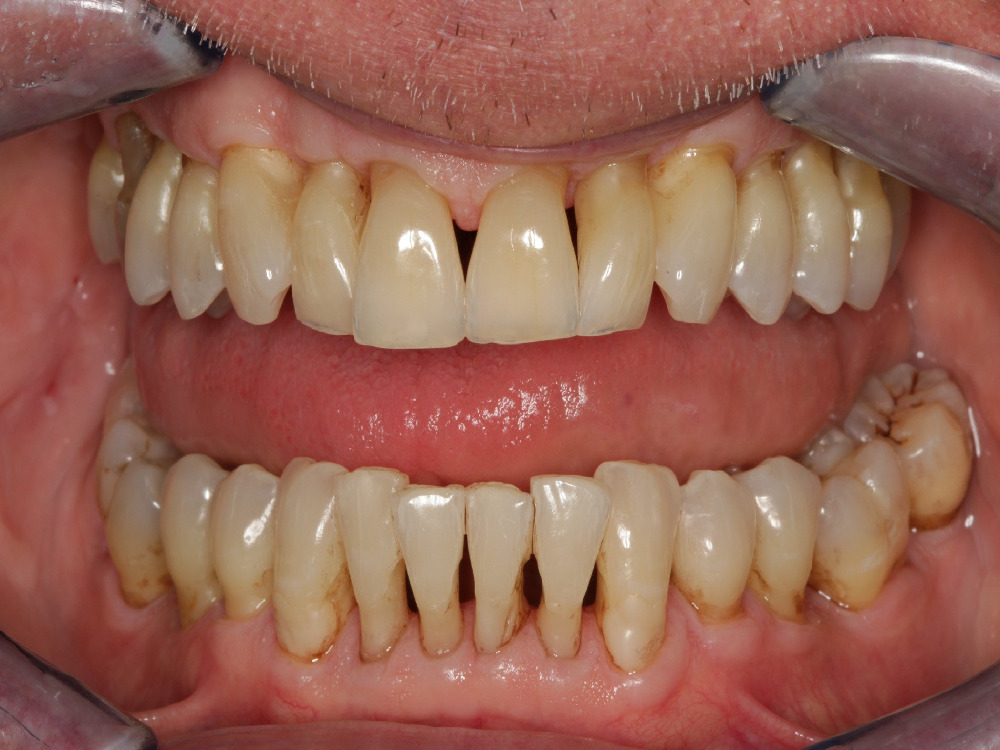 Causes de la récession gingivale 2026