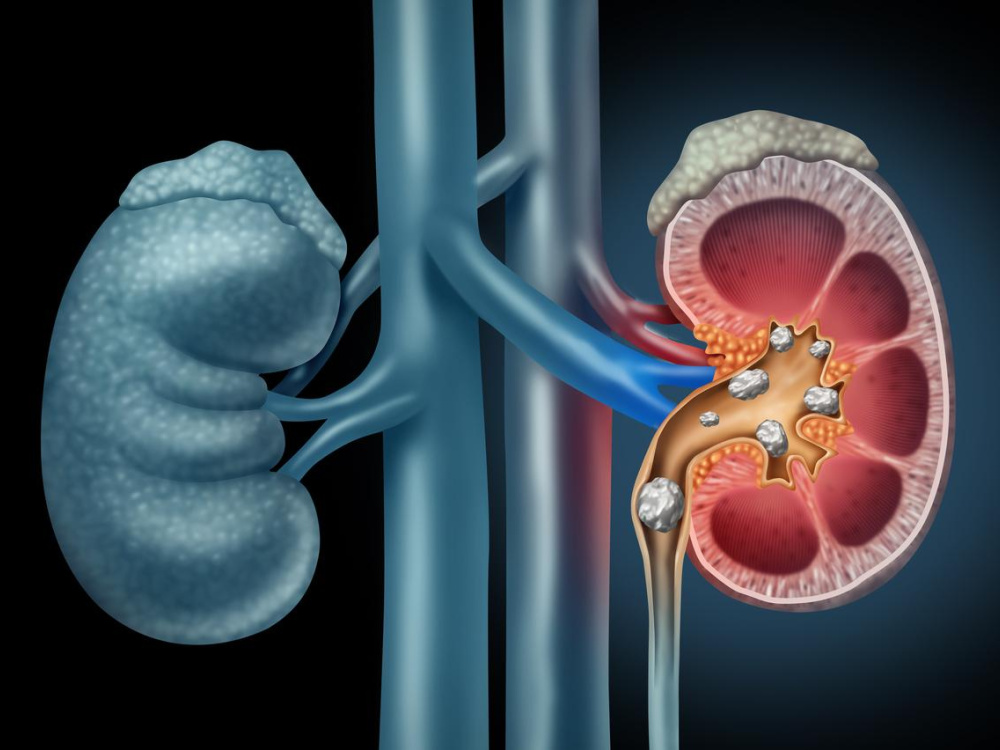 Donor and recipient selection criteria for kidney transplant