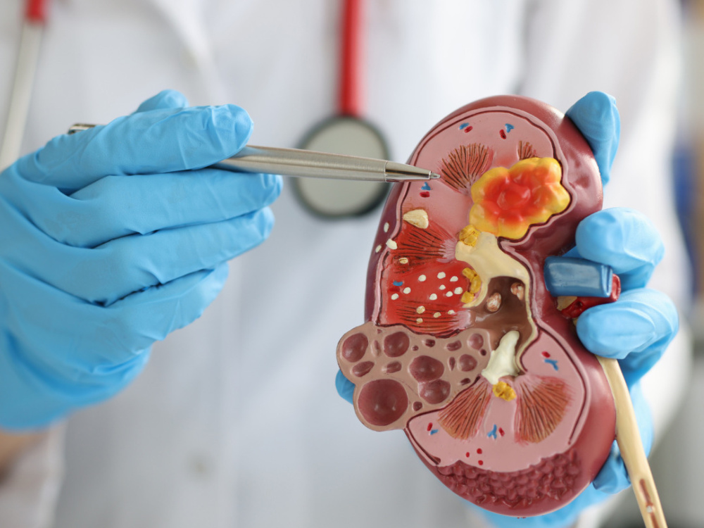 Life after kidney transplant: What really changes 2026