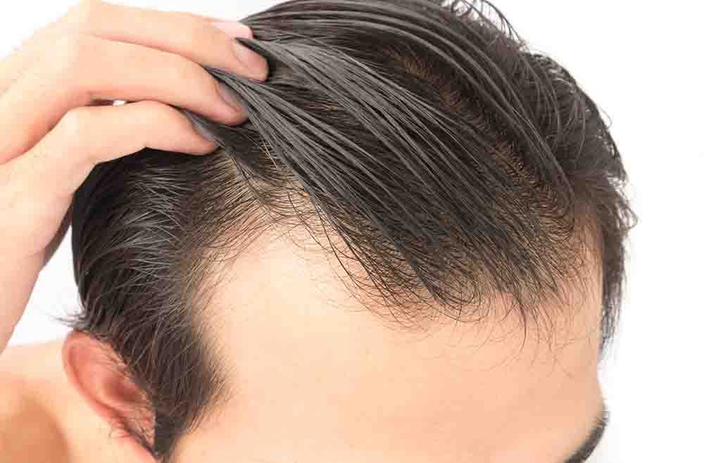 Greffe de Cheveux & Implant capillaire en Turquie au meilleurs oprix