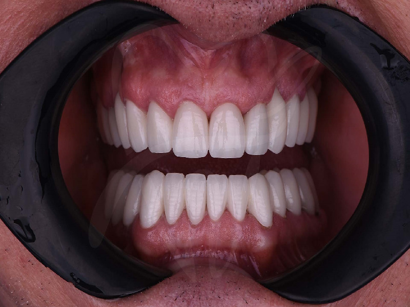 traitement du Hollywood Smile