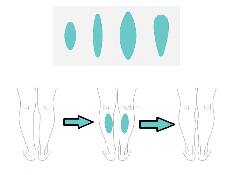 What is a calf implant and who is it for? 2026