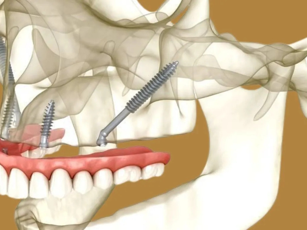 Quels sont les avantages des implants zygomatiques par rapport à la greffe osseuse ? 2026 Quels sont les avantages des implants zygomatiques par rapport à la greffe osseuse ? 2026