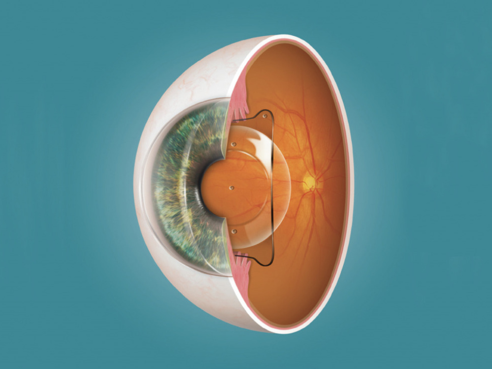 Qu’est-ce que les implants phakes ICL ? 2026
