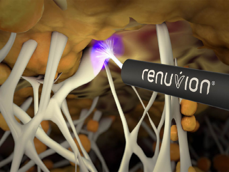 J plasma Renuvion in Turkey