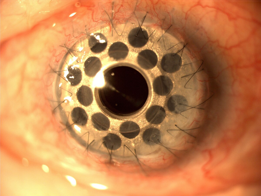 Corneal transplant surgery Turkey