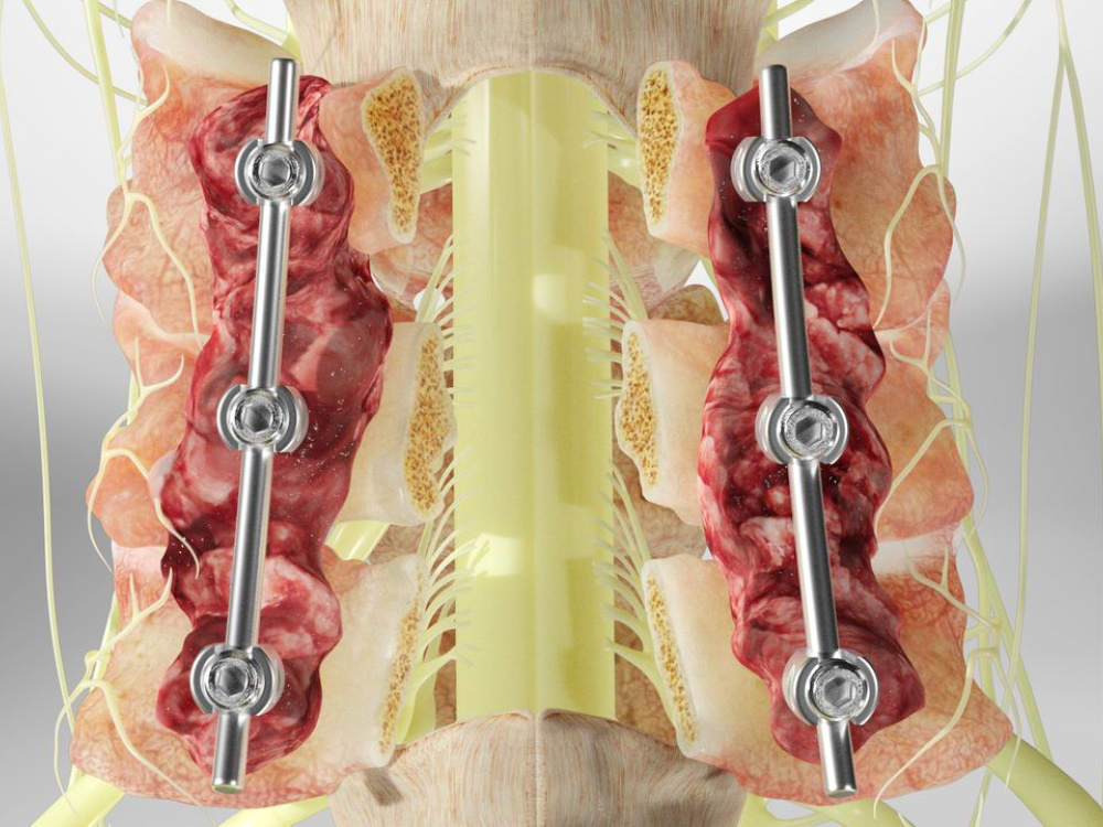 Quand envisager une intervention de laminectomie ? 2026