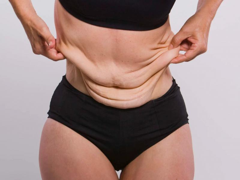 Belt lipectomy in Turkey