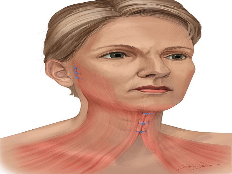 عملية تجميل وشد الرقبة جراحياً في تركيا 2026