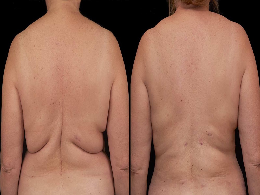 How is a back lift performed in Istanbul, Turkey? 2026 How is a back lift performed in Istanbul, Turkey? 2026