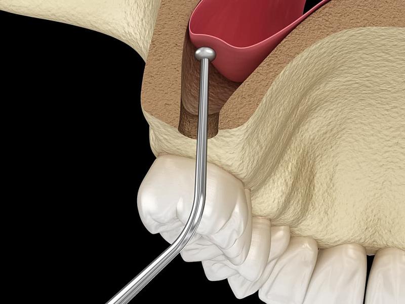 Sinus lift en Turquie