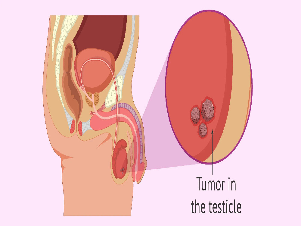 Why undergo an orchiectomy? 2026