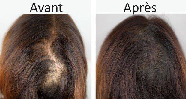 Traitement Des Pertes De Cheveux en Turquie Avis, Prix à partir de 800