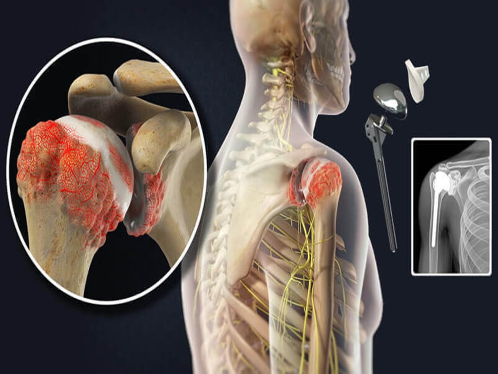Total shoulder replacement Total shoulder replacement