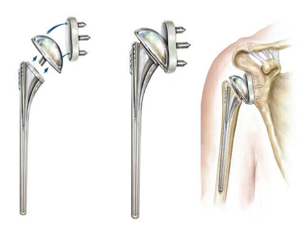 shoulder prostheses shoulder prostheses