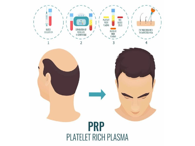 PRP for Hair Loss in Turkey Reviews, Price from 150