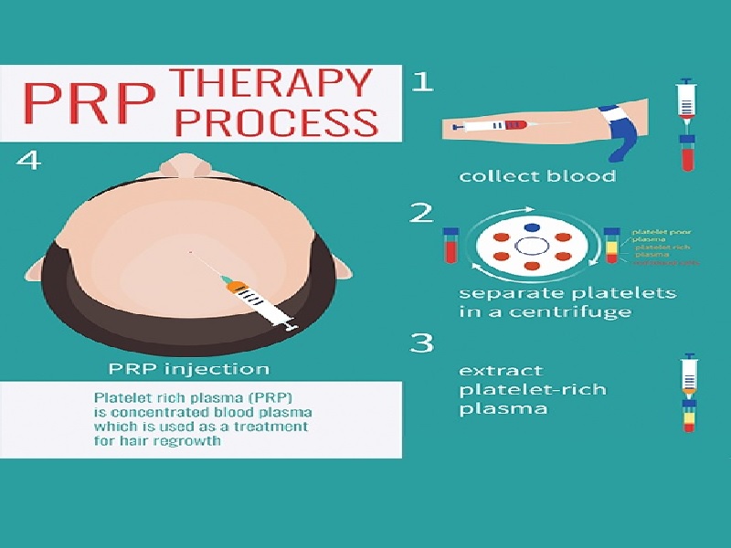 Prp For Hair Loss In Turkey Reviews, Price From 150