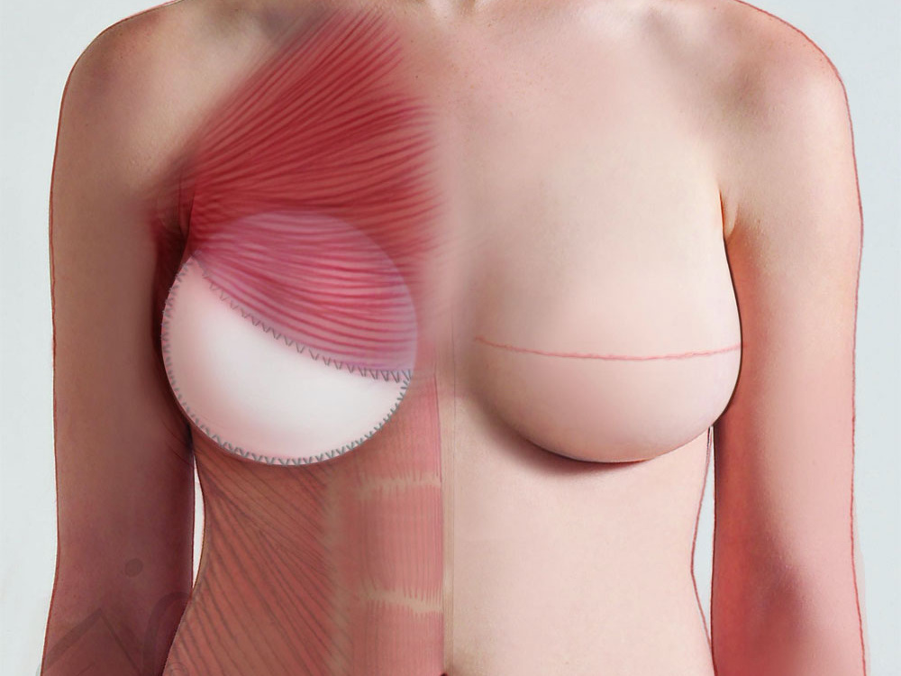 The goals of breast reconstruction 2026