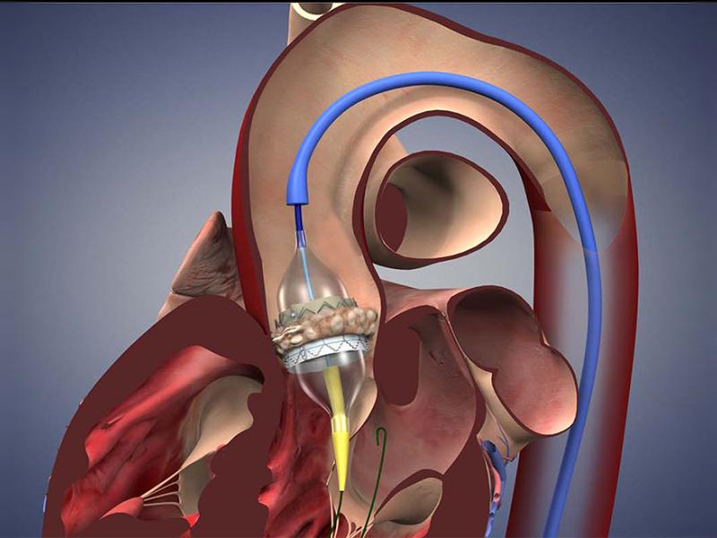 Remplacement valvulaire aortique par voie transcathéter (TAVI) 